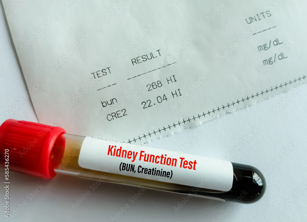 Blood sample tube with laboratory report of serum creatinine and Blood urea nitrogen or BUN for