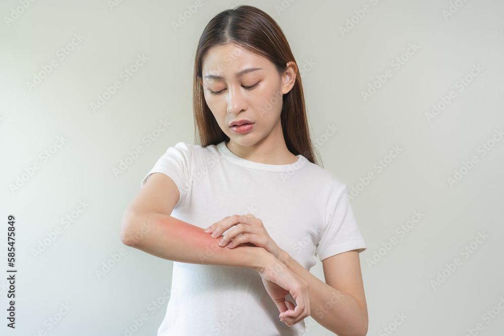 Dermatology asian young woman, girl allergy, allergic reaction from