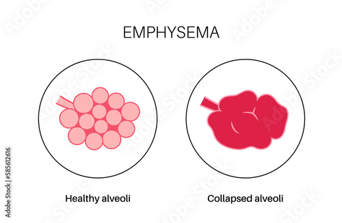 Emphysema anatomical poster