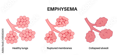 Emphysema anatomical poster