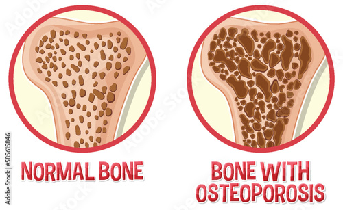 Comparison of normal bone and bone with Osteoporosis