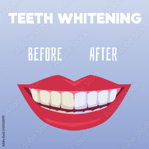 Squared banner about teeth whitening flat style, vector illustration