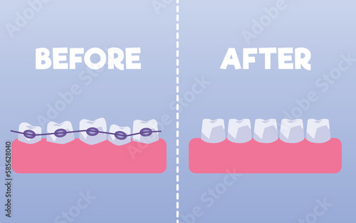 Teeth before and after braces flat style, vector illustration