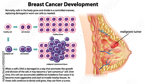 Cancer Development vector with information