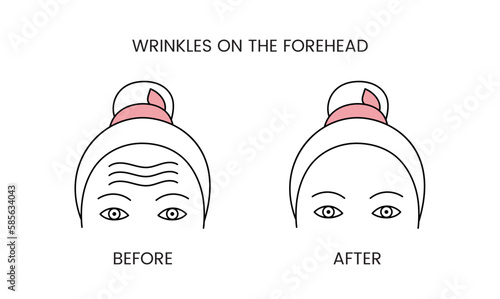 Wrinkles on the forehead, laser cosmetology before procedure and after applying treatment line icon in vector. Illustration of a woman with smooth clean skin and problematic skin.