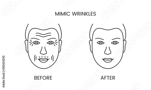 Mimic wrinkles, laser cosmetology before procedure and after applying treatment line icon in vector. Illustration of a man with smooth clean skin and wrinkles