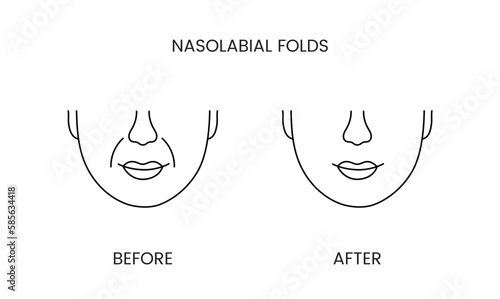 Nasolabial folds, laser cosmetology before procedure and after applying treatment line icon in vector. Illustration of a man with smooth clean skin and wrinkles