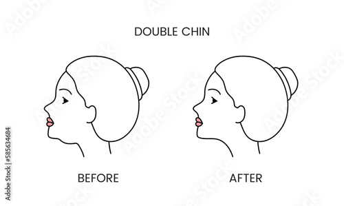 Double chin, laser cosmetology before procedure and after applying treatment line icon in vector. Illustration of a woman with smooth clean skin and problematic skin.