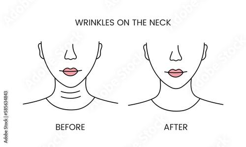 Wrinkles on the neck, laser cosmetology before procedure and after applying treatment line icon in vector. Illustration of a woman with smooth clean skin and problematic skin.