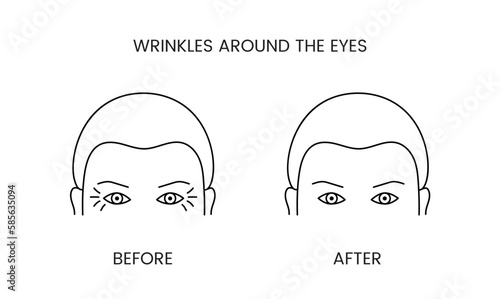 Wrinkles around the eyes, laser cosmetology before procedure and after applying treatment line icon in vector. Illustration of a man with smooth clean skin and wrinkles.