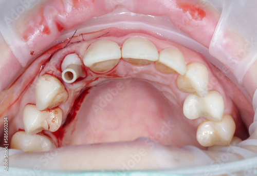 tooth extraction with simultaneous implantation and insertion. dentistry. human open mouth. high quality close-up photo.