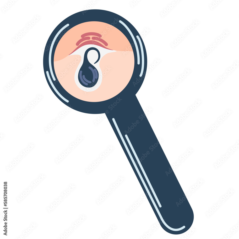 Ingrown hair under a magnifying glass. Inflammation, skin problems. Anatomy infographics of hair. Vector illustration isolated on the white background. Ingrown hair under a magnifying glass. Inflammation, skin problems. Anatomy infographics of hair. Vector illustration isolated on the white background.