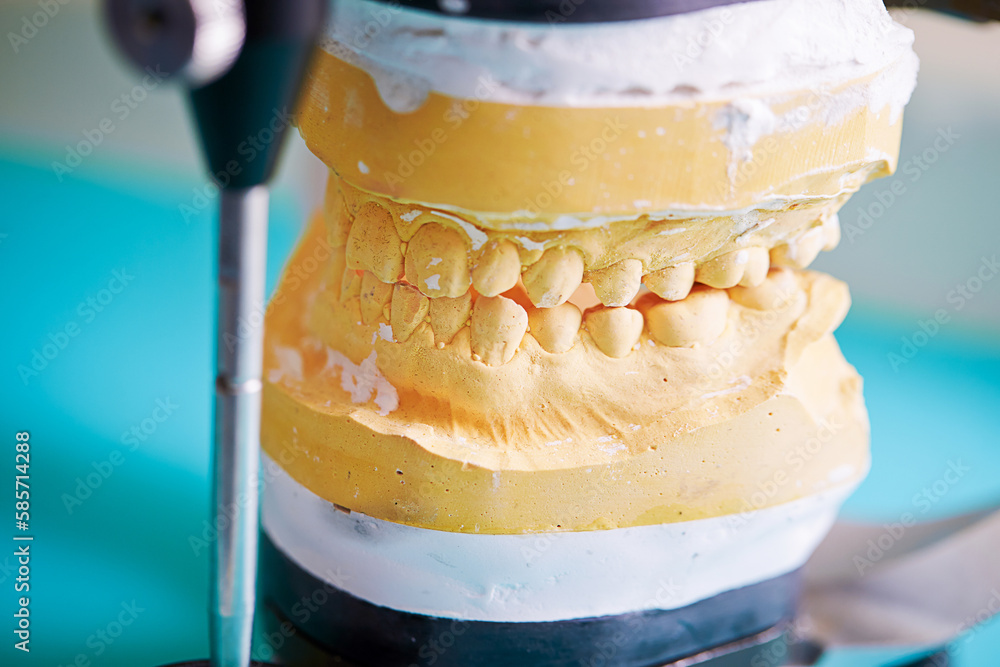 dental prosthetic plaster teeth, dental braces Stock Photo Adobe Stock