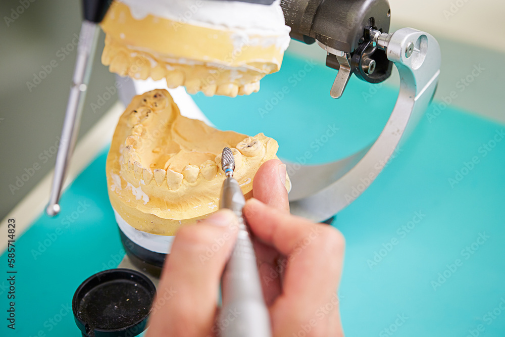 dental prosthetic plaster teeth, dental braces Stock Photo Adobe Stock
