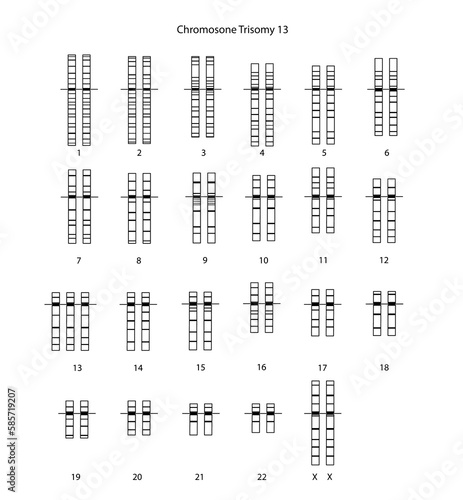 Chromosome Trisomy 13