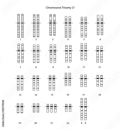 Chromosome Trisomy 21