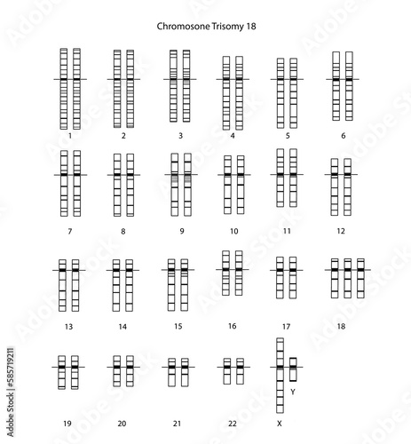 Chromosome Trisomy 18