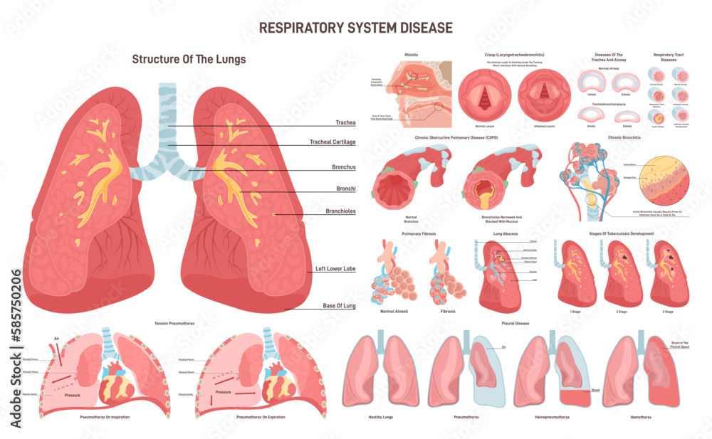 Respiratory tract diseases set. Inflammatory disease and pathological
