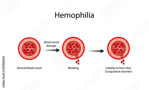 Hemophilia, a bleeding disorder that slows the blood clotting. Haemophilia (Coagulation disorder). Damaged blood vessel, hemorrhage. Healthy blood vessel after bleeding. Vector illustration.