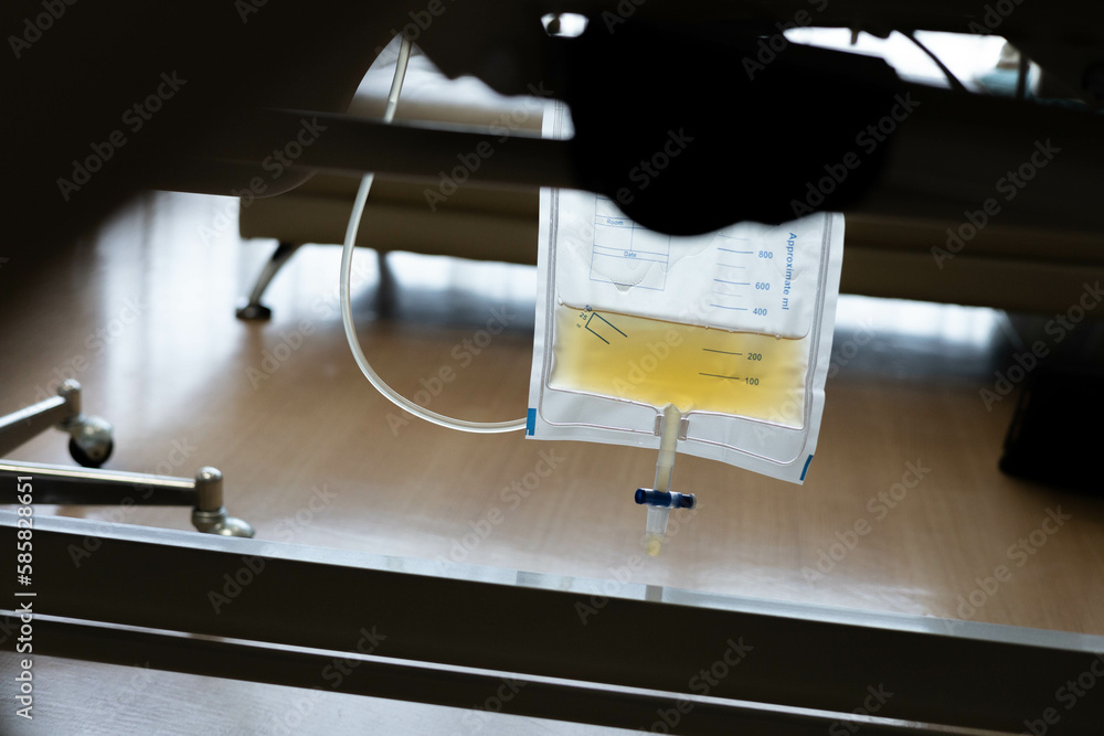 Urine bag, Wound and Ostomy ,Kidney Stone, an old patient have relaxing