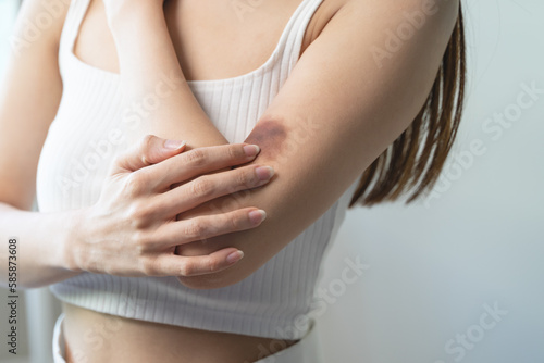 Wallpaper Mural woman get injured and have bruised on her arm. Torontodigital.ca