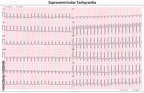 ECG Supraventricular Tachycardia (SVT) - 12 Lead ECG Common Case - 6 Sec/lead - Vector Illustration