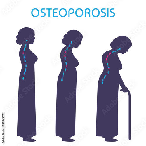 illustration of final stage of osteoporosis, joint pain medical vector infographic
