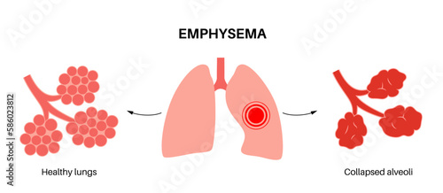 Emphysema anatomical poster
