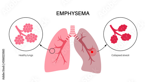 Emphysema anatomical poster