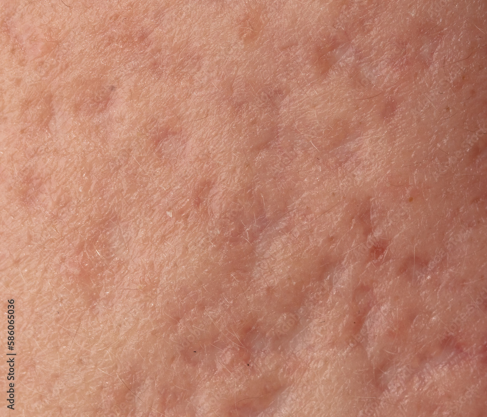 Fototapeta premium Acne scars on the skin. Macro.