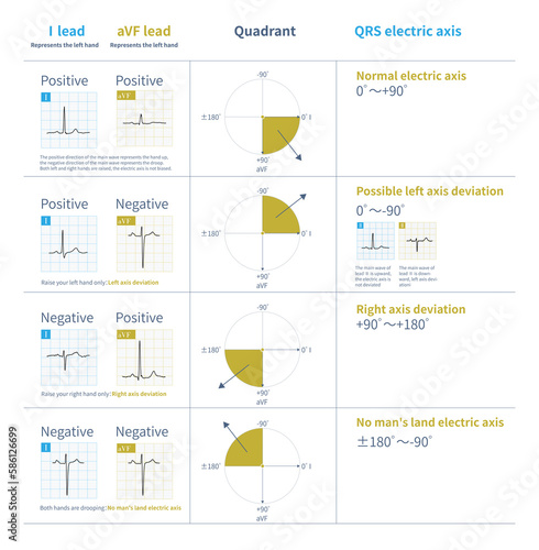 According to the polarity of QRS main wave in lead I and aVF, combined with raising or lowering the left and right hands, the frontal QRS electric axis can be visually measured.