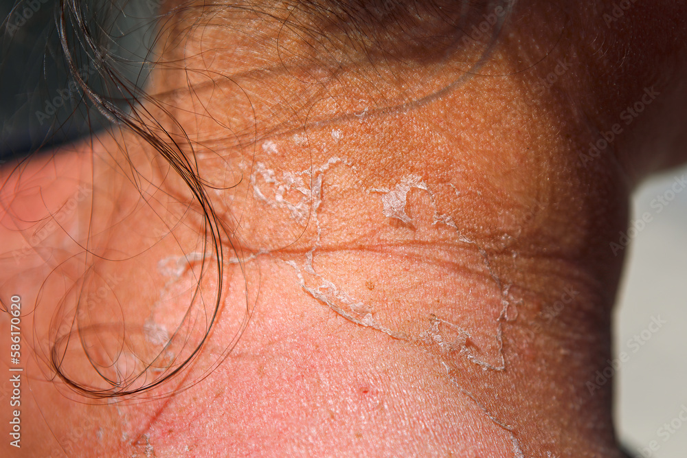 Peeling skin on the neck after sunburn . Consequences sun tan Peeling skin on the neck after sunburn . Consequences sun tan