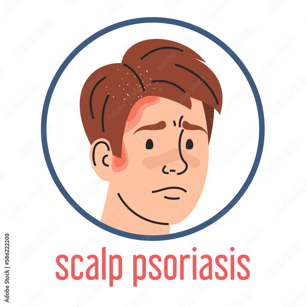 Scalp Psoriasis Vector Isolated Medical Condition Dermatology Disease Sad Man With Red Itchy 6461