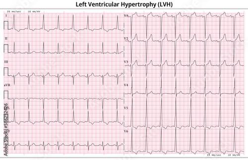 ECG Left Ventricular Hypertrophy (LVH) - Left Ventricular Enlargement - 12 Lead ECG Common Case - 6 Sec/lead - Vector Illustration photo