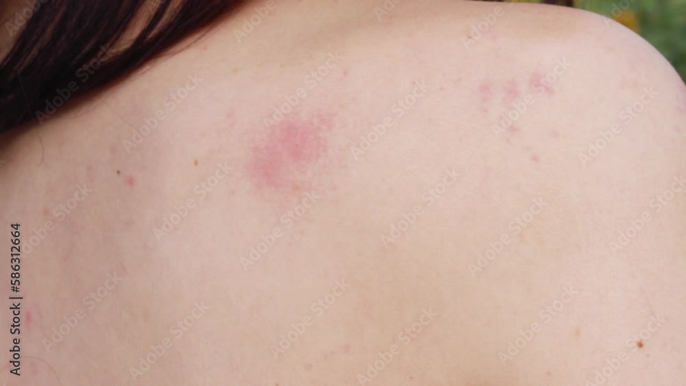 Woman standing outside street scratching redness from insect bite, itching shoulder arm mosquito bite in summer. Wound red spot after tick mite on skin, bee sting. Dermatology, allergy reaction
Woman standing outside street scratching redness from insect bite, itching shoulder arm mosquito bite in summer. Wound red spot after tick mite on skin, bee sting. Dermatology, allergy reaction