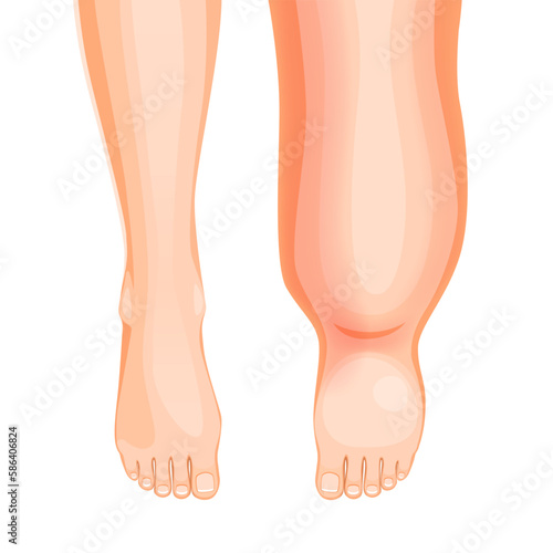 Edema foot. Swollen leg symptom. Fluid retention, thrombosis or tissue inflammation in legs, lymph circulation medical problem or overweight or oedema syndrome with vector swollen legs