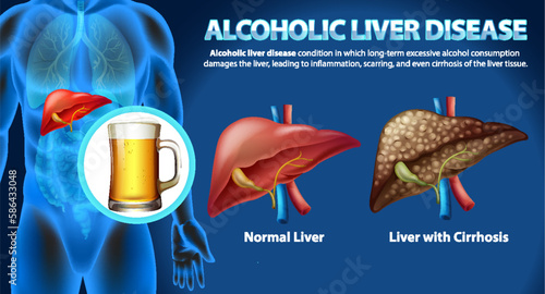 Informative poster of alcoholic liver disease Cirrhosis