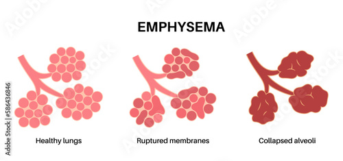 Emphysema anatomical poster