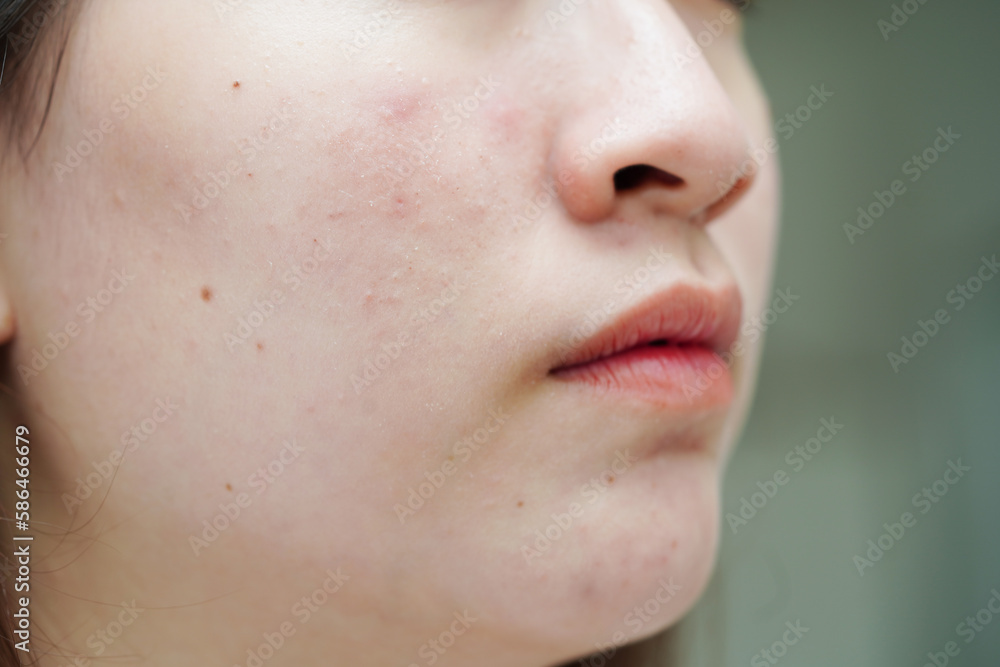 Obraz premium Acne pimple and scar on skin face, disorders of sebaceous glands, teenage girl skincare beauty problem.