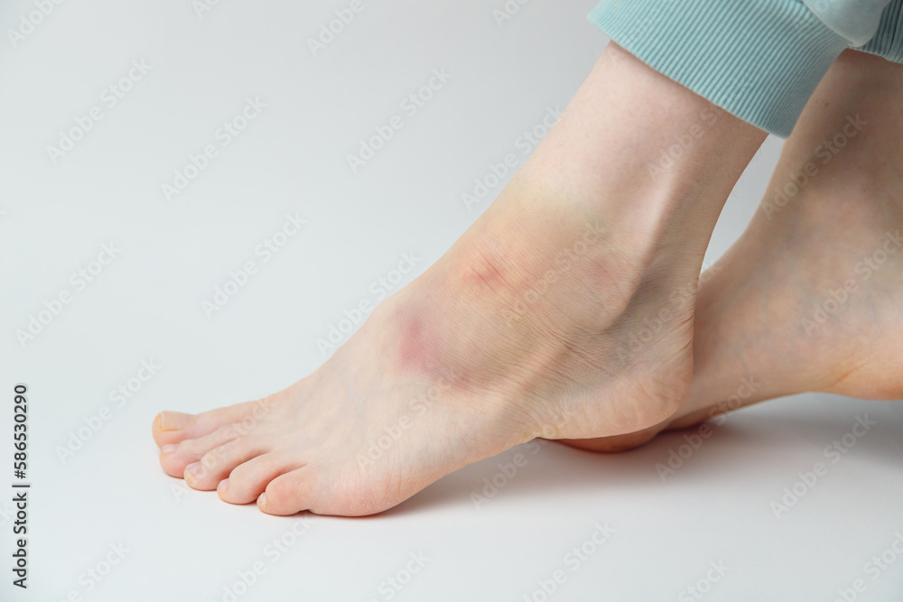 Sprained ankle with bruise and swelling on a female left foot on white background - obrazy, fototapety, plakaty 
