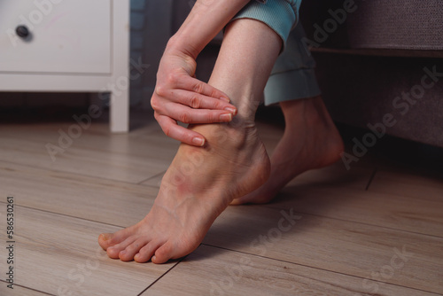 Woman apply ointment on ankle with bruise and swelling on her foot at home © vladdeep