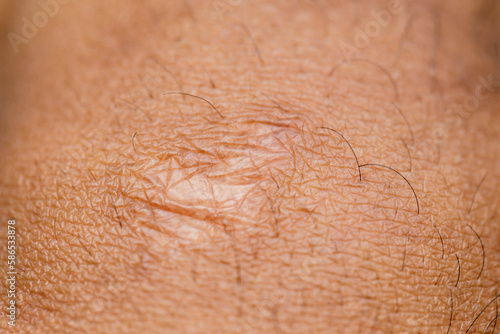 Close up of cyanotic keloid scar caused by surgery and suturing photo