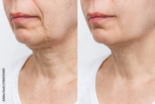 Tela Lower part of the face and neck of elderly woman with signs of skin aging before and after facelift, plastic surgery on white background