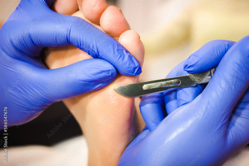 Foot treatment in SPA salon. Medical pedicure procedure using special  instrument with blade knife holder. Professional pedicure using dieffenbach  scalpel. Stock Photo