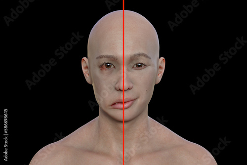 Facial palsy in a man, 3D illustration highlighting the asymmetry and drooping of the facial muscles on one side of the face