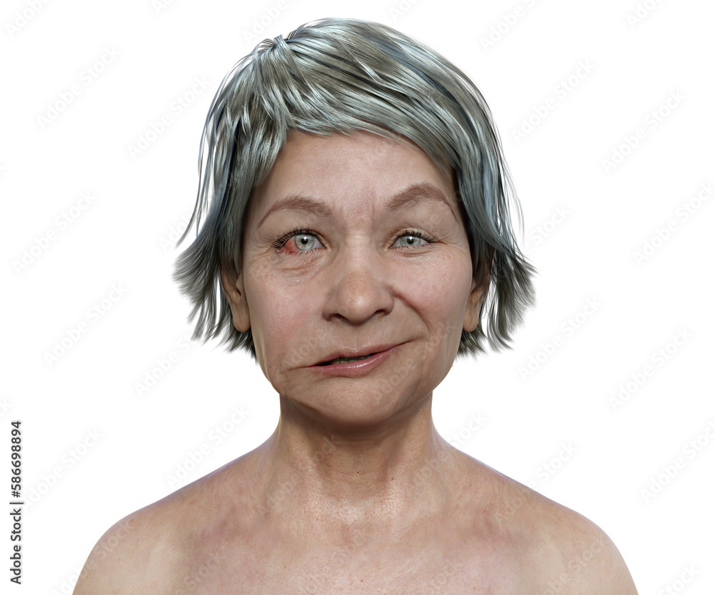 Facial palsy in a woman, 3D illustration highlighting the asymmetry and