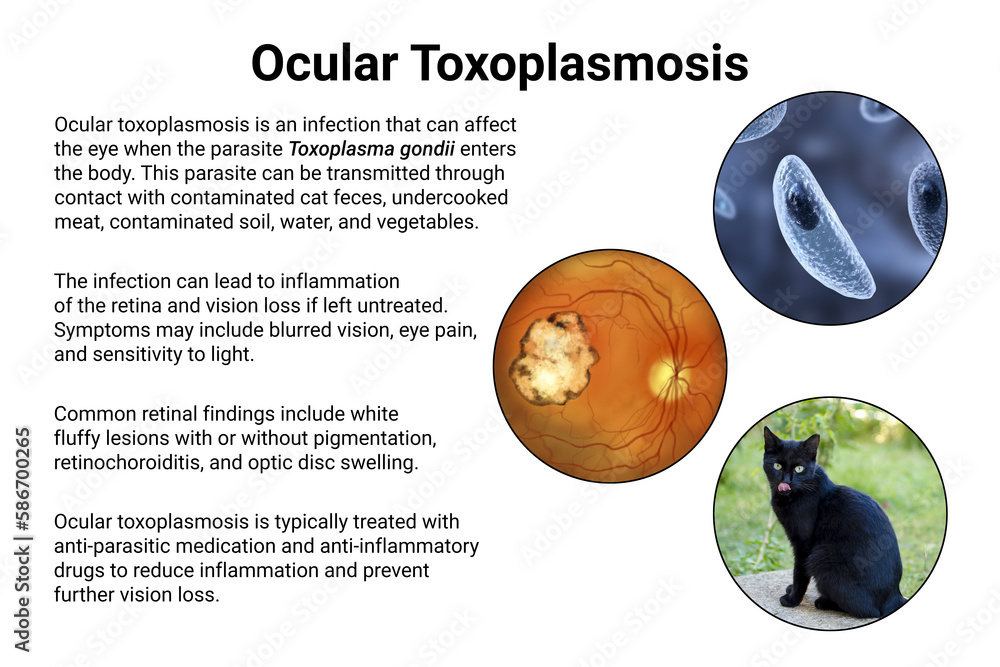 Ocular toxoplasmosis, retinal scar caused by a Toxoplasma gondii