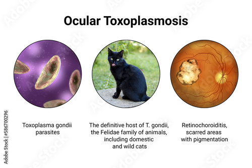 Ocular toxoplasmosis, retinal scar caused by a Toxoplasma gondii infection, scientific illustration photo