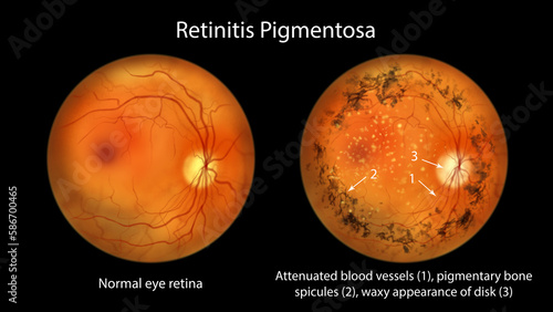 Retinitis pigmentosa, a genetic eye disease leading to vision loss. An illustration shows normal eye retina and pigment depositis in the affected retina photo