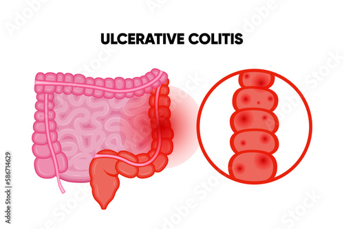 Ulcerative Colitis. Inflammatory bowel disease. Ulcer and inflammation of the digestive tract, abdominal pain. Human internal organ, anatomy, medicine concept, healthcare.